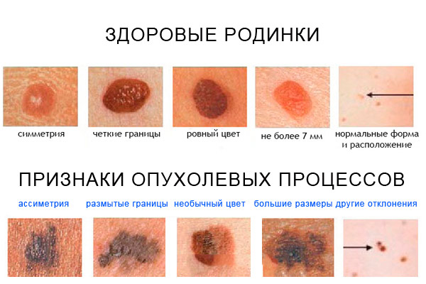 признаки меланомы кожи